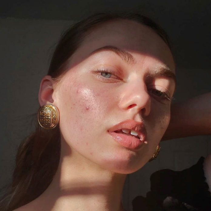 How to get rid of pimples?